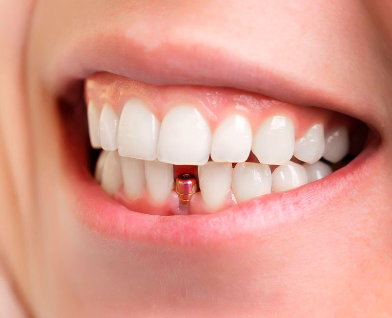 Tratamiento de implantes dentales en Clínica dental en Silla