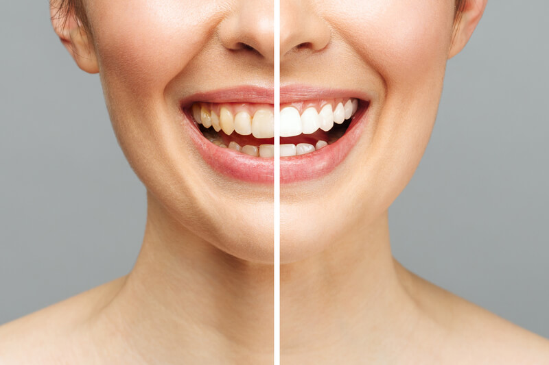 Antes y después de un blanqueamiento dental