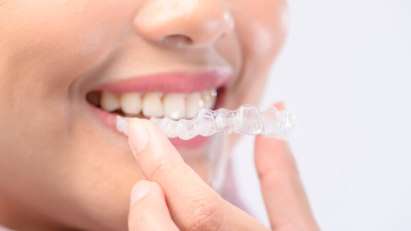 Mujer poniéndose una férula transparente en los dientes