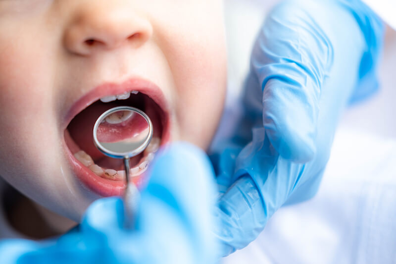 closeup-open-mouth-child-and-mirror-in-dentists-hands-in-blue-gloves-checkup-examine-treating-teeth-to-child-health-care-children-dental-hygiene