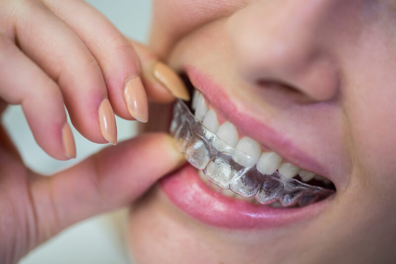 Imagen de una mujer usando brackets invisibles de silicona en Silla, un tratamiento de ortodoncia moderno y efectivo que te permitirá corregir la alineación de tus dientes de manera discreta y cómoda, mejorando tu sonrisa y tu salud bucal.
